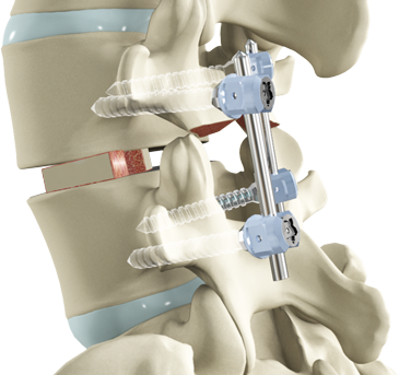 Lumbar Fusion Surgery