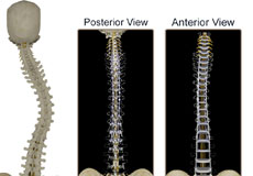 Anterior and Posterior Scoliosis Surgery