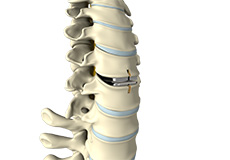 Lumbar Artificial Disc Replacement