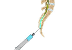 Caudal Epidural Injection