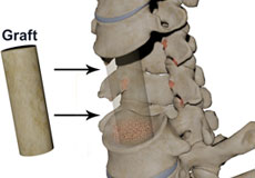 Cervical Corpectomy and Strut Graft