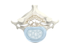 Cervical Stenosis