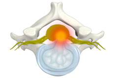 Cervical Disc Protrusion