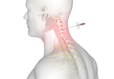 Cervical Epidurals