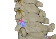 Cervical Facet Blocks