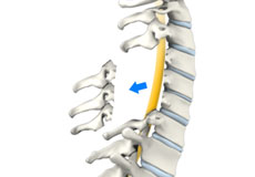 Laminectomy