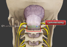 Chiari Malformation