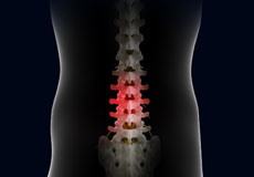 Complications of Spinal Surgery