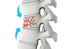 Spinal Fractures