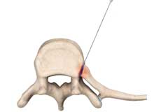 Costo-vertebral Joint Injection