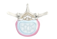 Degenerative Disc Disease