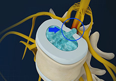 Disc Herniation