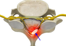 Epidural Abscess