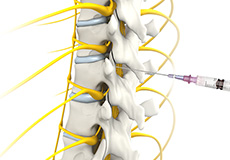 Epidural Spinal Injection
