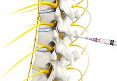 Epidural Spinal Injection