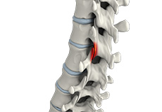 Facet Joint Arthritis