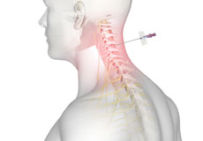 In-Office Cervical Injections