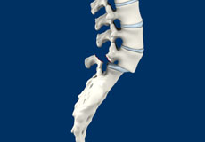 Isthmic Spondylolisthesis