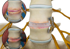 Lateral Lumbar Interbody Fusion