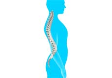 Lordosis