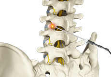 Radiofrequency Ablation