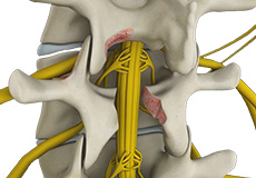 Spinal Decompression