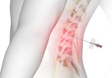 Lumbar Epidurals