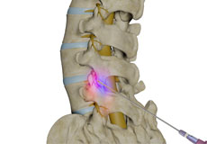 Lumbar Facet Block