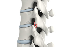 Lumbar Facetectomy and Foraminotomy