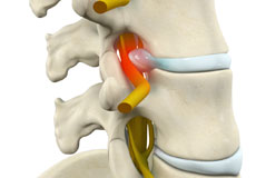 Lumbar Radiculopathy