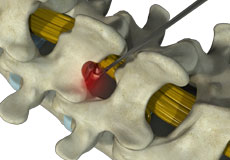 Microdiscectomy