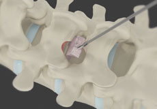 Minimally Invasive Lumbar Discectomy