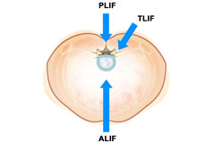 Minimally Invasive Lumbar Fusion