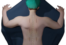 Minimally Invasive Scoliosis Surgery