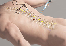 Minimally Invasive Spine Surgery