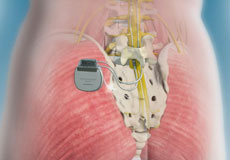 Neuromodulation