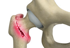 Osteoporotic Fractures