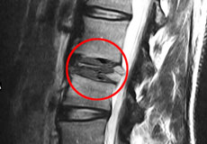 Pathological Fractures of the Spine