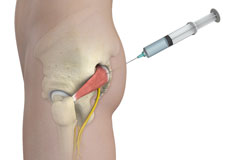 Piriformis Muscle Injection