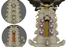 Posterior Cervical Decompression