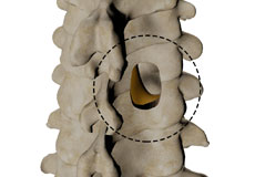 Posterior Cervical Foraminotomy
