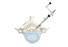 Posterior Cervical Microforaminotomy/Discectomy