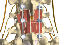 Posterolateral Lumbar Fusion