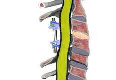 Pseudarthrosis/Nonunion