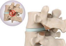 Removal of Facet Joint Cyst