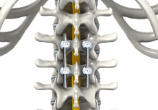 Spinal Fusion