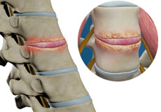 Spinal Infection Debridement