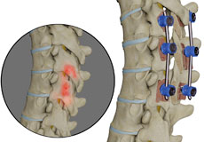Spinal Infection Stabilization