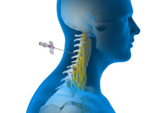 Spinal Nerve Blocks
