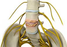 Spine Bone Spurs